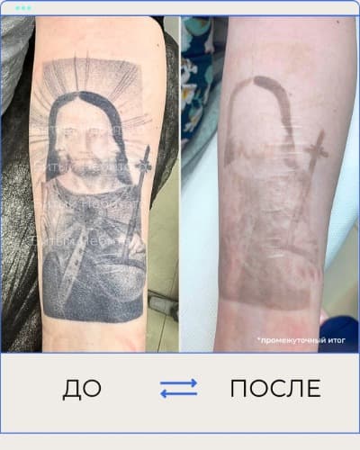 Удаление татуировки
